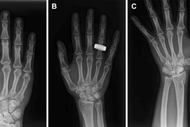 hand-x-rays